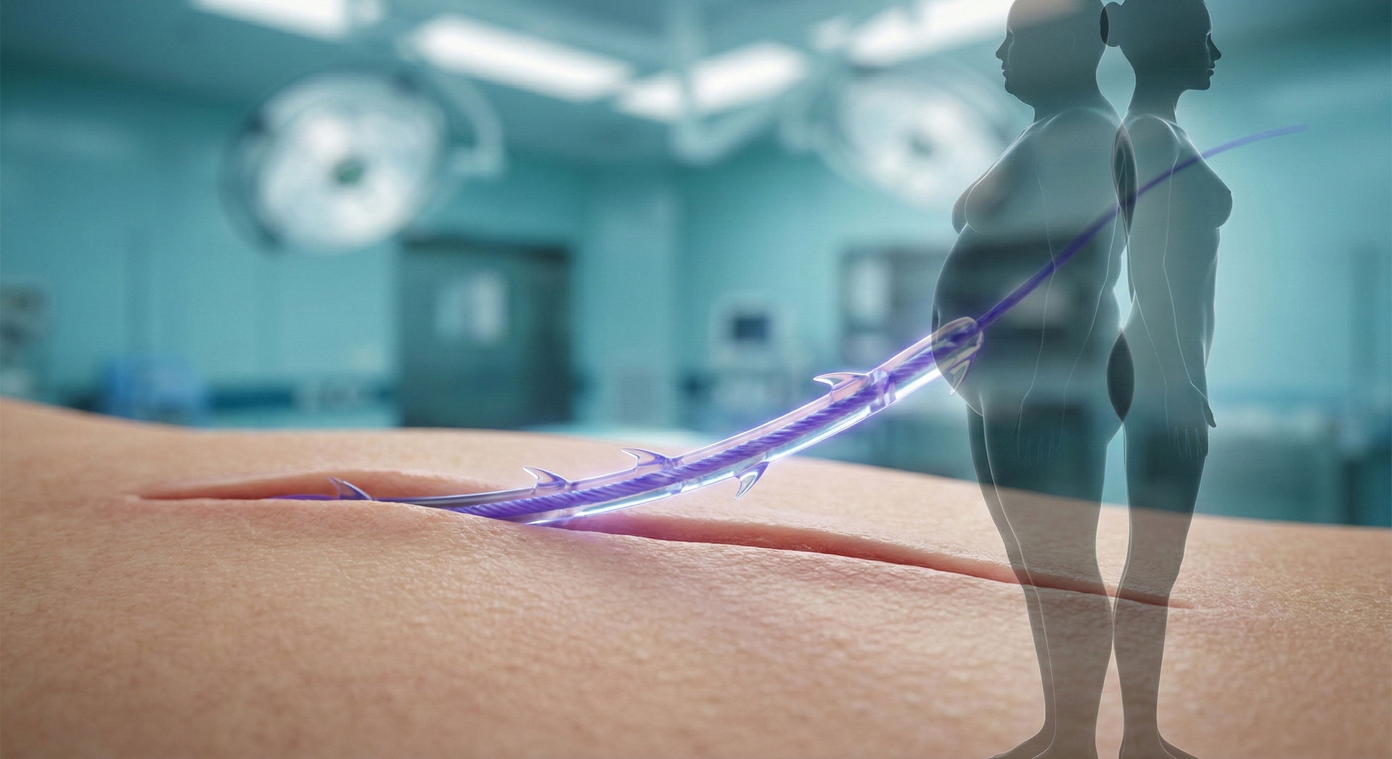 Der „Ozempic-Effekt“ im OP: Warum der Body-Contouring-Boom 2026 nach einer neuen Naht-Strategie verlangt