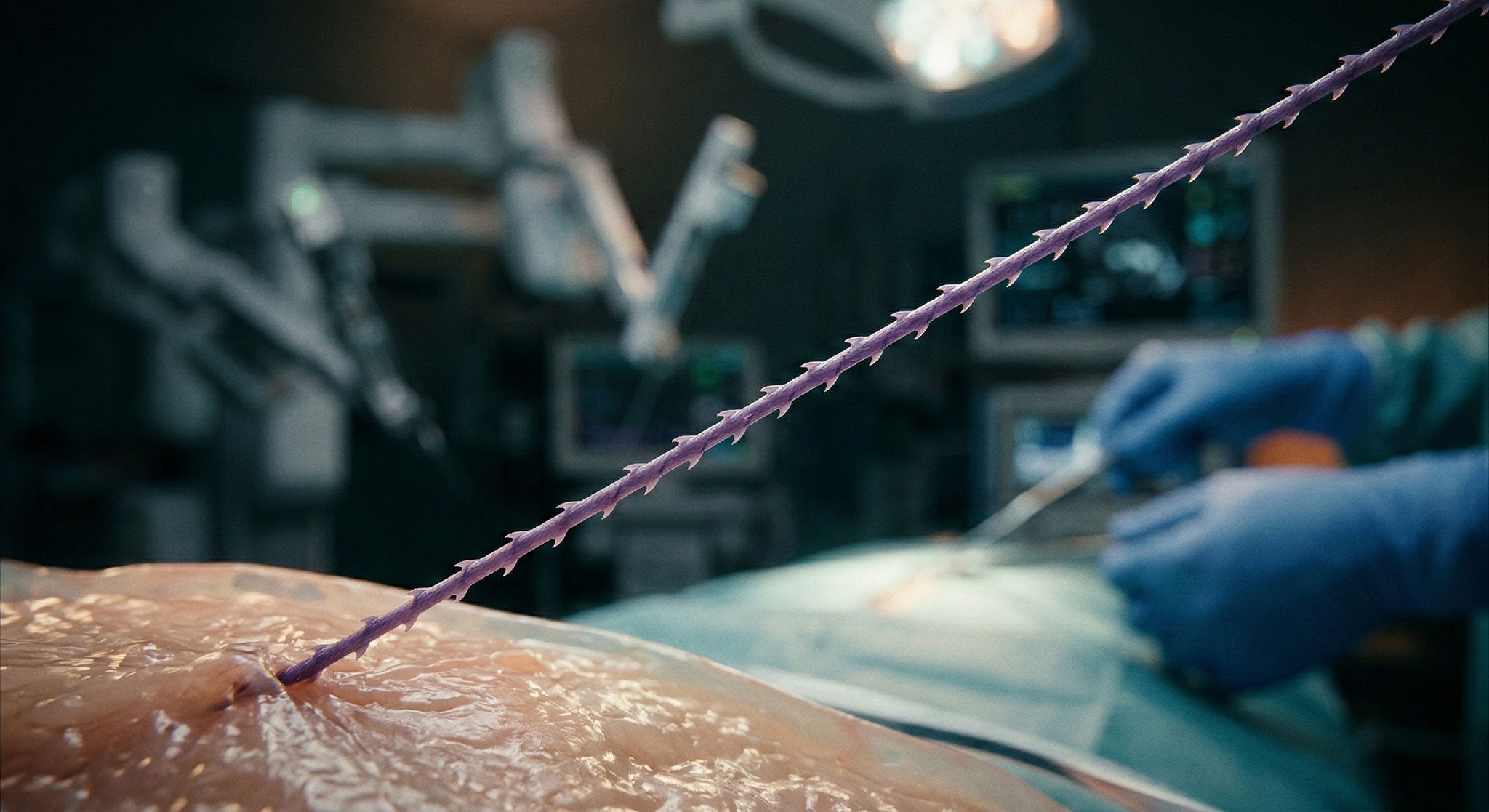 Knotenloses Nahtmaterial mit Widerhaken (Barbed Sutures): Auswahl, Vorteile, Grenzen und Vergleich Stratafix vs V-Loc